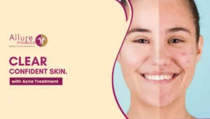 Acne Treatment 300x170 1