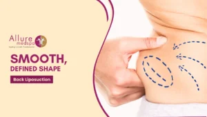 Back Liposuction 300x170 1