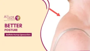 Buffalo Hump Liposuction 300x170 1