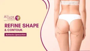 Buttocks Liposuction 300x170 1