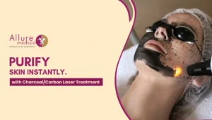 Charcoal Laser Treatment 300x170 1