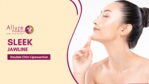 Double Chin Liposuction 300x170 1