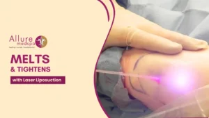 Laser Liposuction 300x170 1