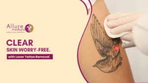 Laser Tatto Removal 300x170 1