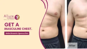 Male Breast Liposuction 300x170 1
