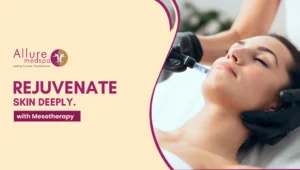 Mesotherapy 300x170 1