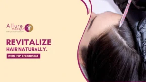 PRP Treatment 300x170 1