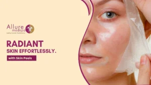 Skin Peels 300x170 1