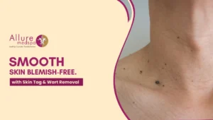 Skin tag removal 300x170 1
