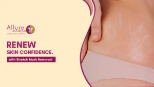 Stretch mark Removal 300x170 1