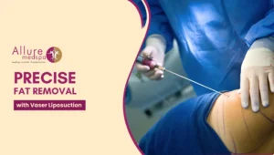 Vaser Liposuction 300x170 1