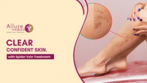 spider vein treatment 300x170 1