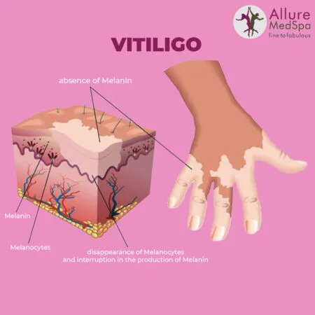 vitiligo 1 450x450 1