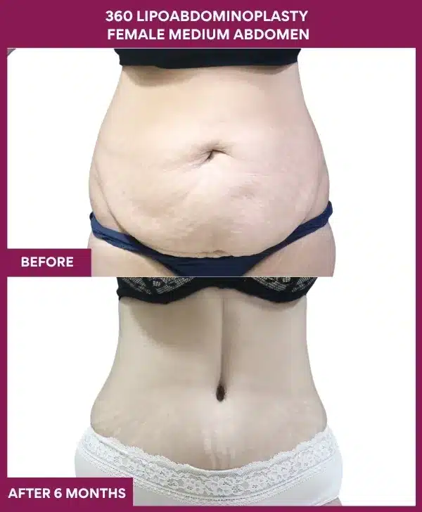 Home 23 360 lipoadominoplasty Before After Image in mumbai, India