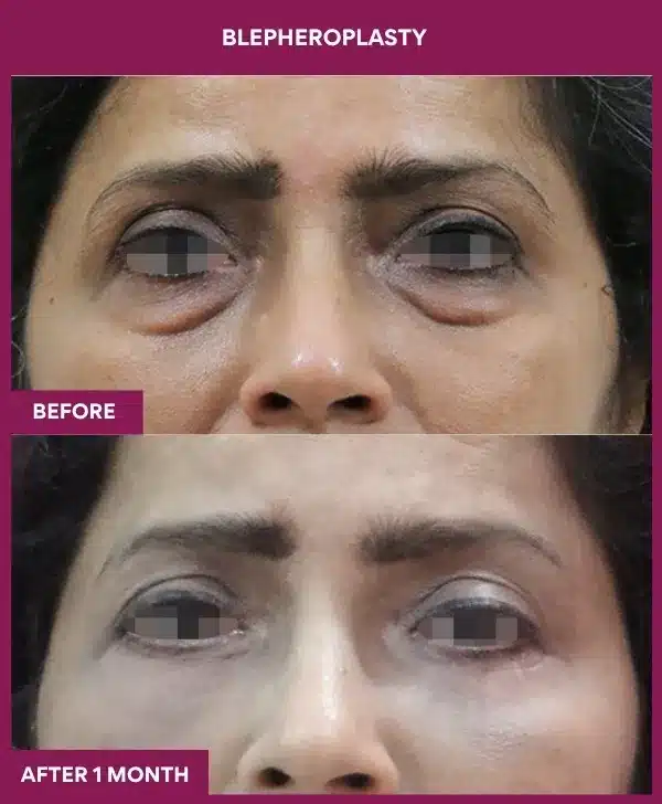 Home 24 Blepheroplasty/ Eyelid Surgery Before After image in mumbai, india
