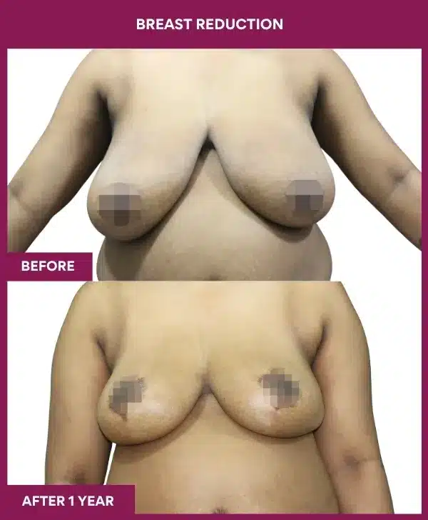 Home 26 Breast Reduction Before After Image in mumbai, india