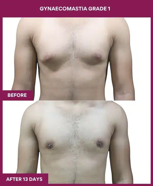 Home 17 Gynecomastia Surgery Grade 1 Before After image in Mumbai, India