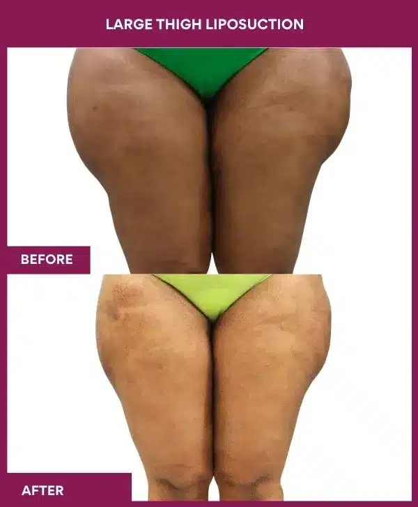 9 Large Thigh Liposuction-- (2)