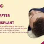 PRP After Hair Transplant in Mumbai, India