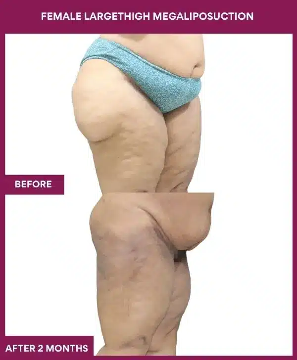 FEMALE LARGE THIGH MEGA LIPOSUCTION in Mumbai, India