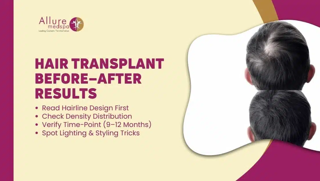 HAIR TRANSPLANT BEFORE–AFTER RESULTS