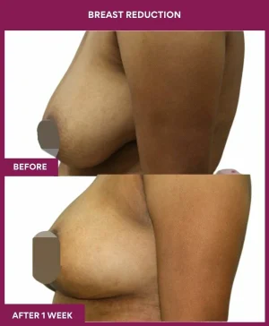 1 BREAST REDUCTION (2)