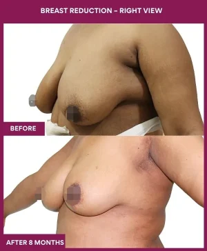 1 Breast Reduction – Right View_2