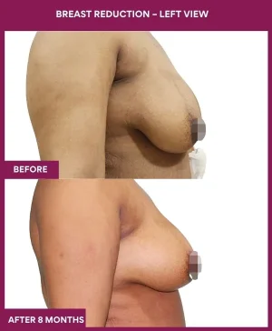 1 Breast Reduction – left View_1