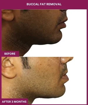 1 Buccal Fat Removal (1)_1