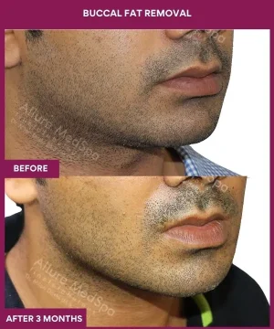 1 Buccal Fat Removal (2)_1