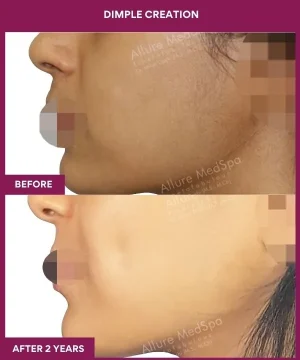Female Dimple Creation surgery in Mumbai, India