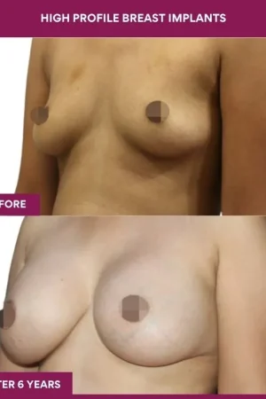 1 High Profile Breast Implants (2)_1