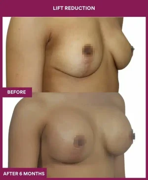 1 Lift reduction (2)