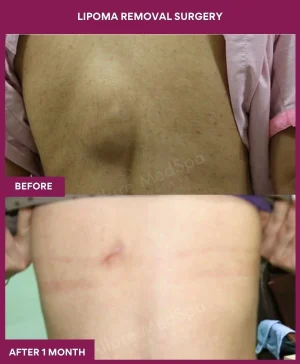 1 Lipoma Removal Surgery