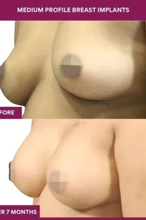 1 Medium Profile Breast Implants (2)_1