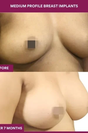 1 Medium Profile Breast Implants (3)_2