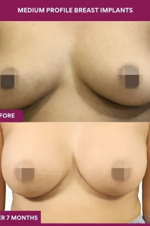 1 Medium Profile Breast Implants_3
