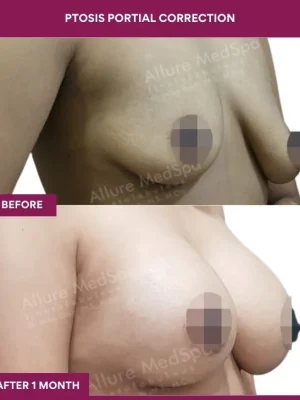 1 Ptosis Portial Correction (2)_1_