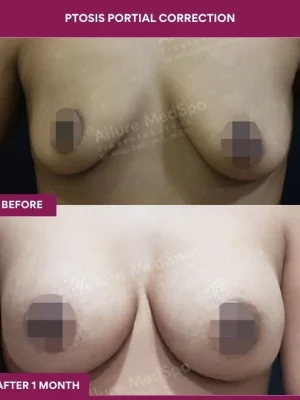 1 Ptosis Portial Correction (4)_1_