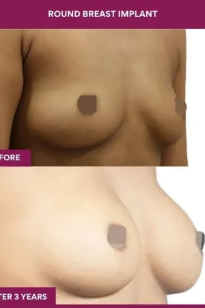 1 Round breast implant (3)_2