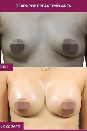 1 Teardrop Breast Implants (4)_1