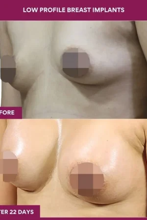 1 low Profile Breast Implants (2)_