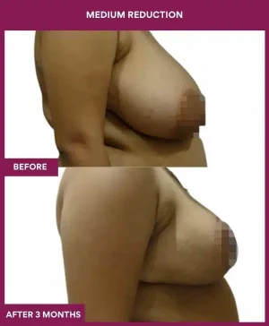 1 medium reduction (3)