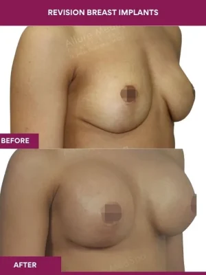 1 revision Breast Implants (2)_1