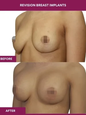 1 revision Breast Implants (3)_2