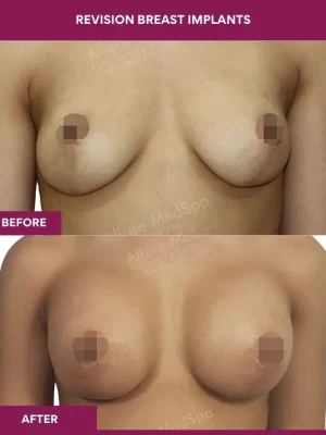 1 revision Breast Implants_3