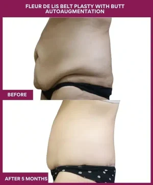 10 Fleur de lis Belt plasty with butt autoaugmentation_ (2)