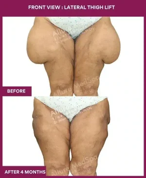 11 Front View _ Lateral Thigh Lift_-