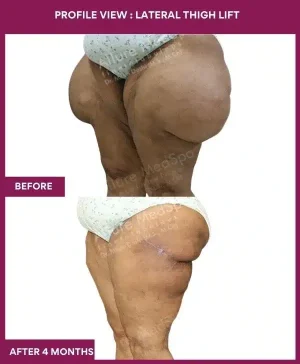 11 Right View Lateral Thigh Lift