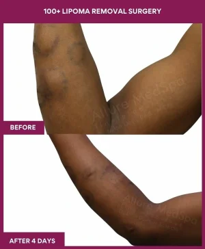 12 100+ Lipoma Removal Surgery